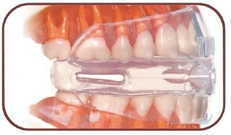 DentalDoc Teeth Grinding Mouth Guard for Kids & Women Prevents ...