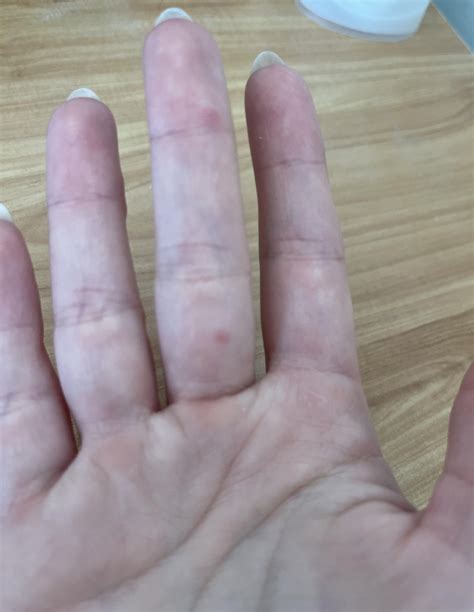 Skincare help/ Question- red bumps on hand : r/SkincareAddicts