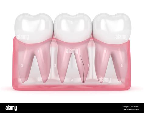 3d render of gums with cracked tooth root over white background. Vertical fracture. Different ...