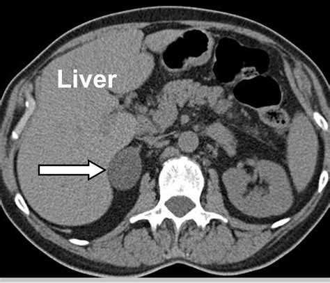 Ct Anatomy Of Adrenal Gland at Adam Fielding blog