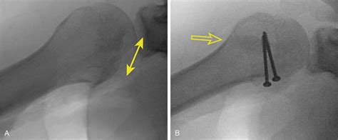 Technique Spotlight: Open Reduction and Bone Grafting of Reverse Hill ...