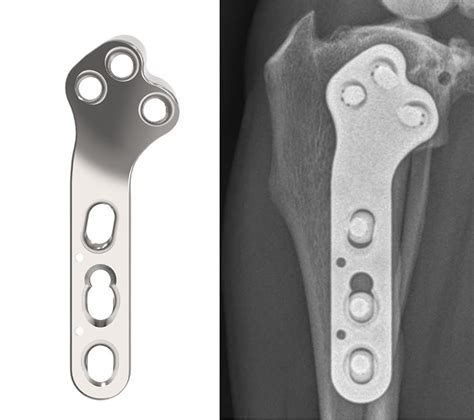 Compression Plate Ao 的图像结果