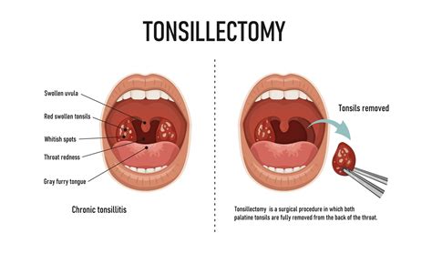 Tonsillectomy Explained | North Carolina Specialty Hospital