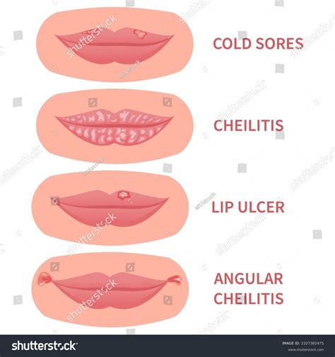 Cold Sore Or Pimple Corner Of Mouth