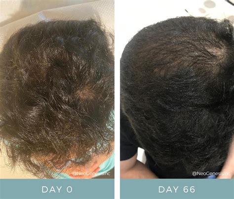 Hair Loss + Microneedling Treatments: Promote Hair Growth