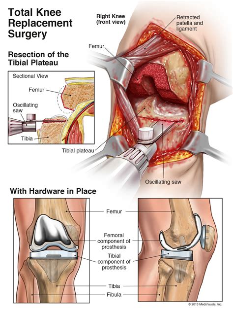 Total Knee Replacement Video