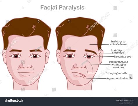 Facial Paralysis Bell Palsy Drooping Eyes Stock Vector (Royalty Free ...