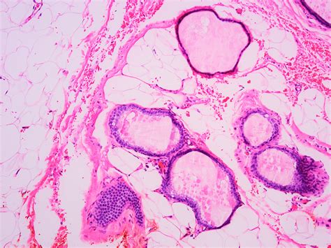 Pathology Outlines - Nonproliferative fibrocystic changes