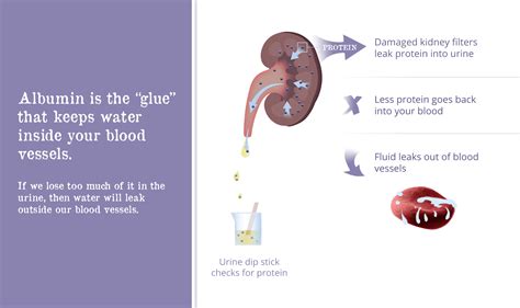 Proteinuria - Gaytri Manek (Formerly Gandotra), MD
