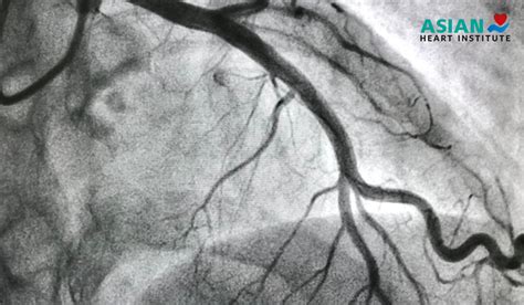 Coronary Angiogram Procedure 的图像结果