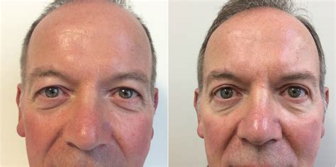 Eyelid Surgery, Blepharoplasty - Traditional vs. Laser Blepharoplasty