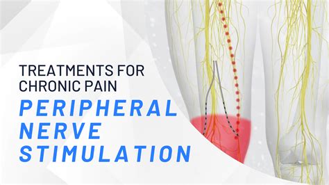 Peripheral Nerve Stimulator - Sound Pain Alliance - What You Need To Know