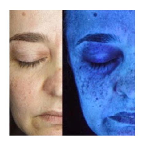 ¿Qué es el melasma y cómo tratarlo? - Ángela Morente Centro de Estética