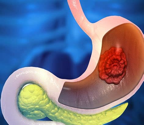 Duodenum Definition 的图像结果