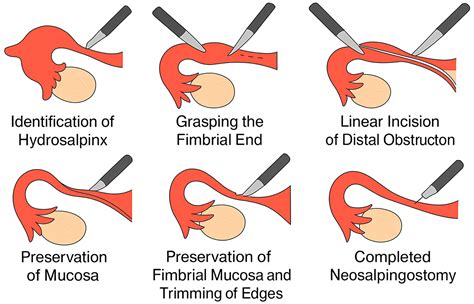 Long-Term Reproductive Outcomes After Palmer-Type Neosalpingostomy in ...