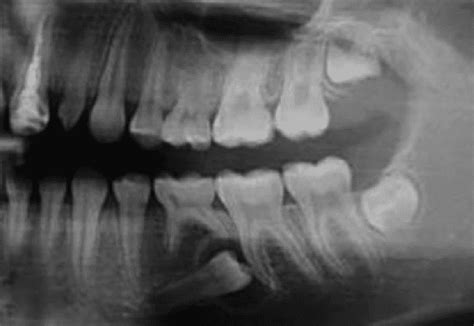 Clasificación de quistes mandibulares de acuerdo con la OMS – Odontogénesis