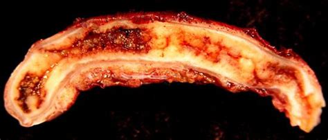 Image result for Dissected Appendix