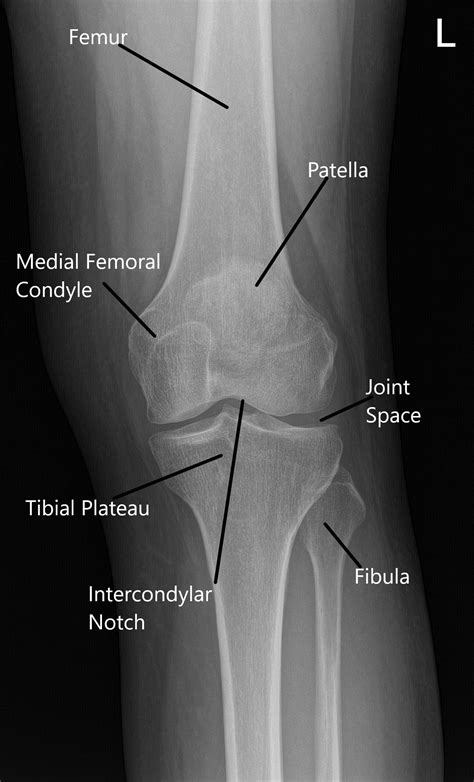 Side View Knee Xray at Dennis Fleming blog