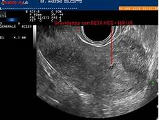 gestazionale senza embrione cause 0 4 settimane gestazionale senza embrione cause 0 4 settimane