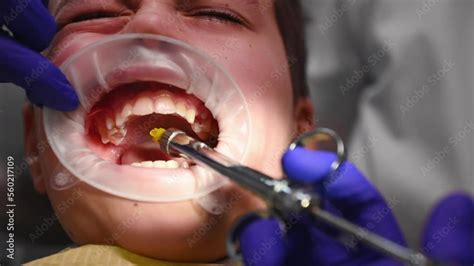 Image result for Tooth Extraction Injection