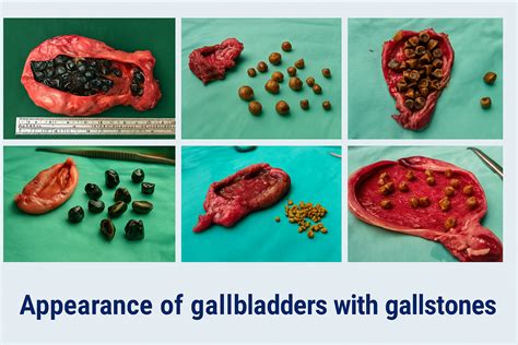 Gallstone Disease Treatment Singapore | Laparoscopic Gallbladder Surgery