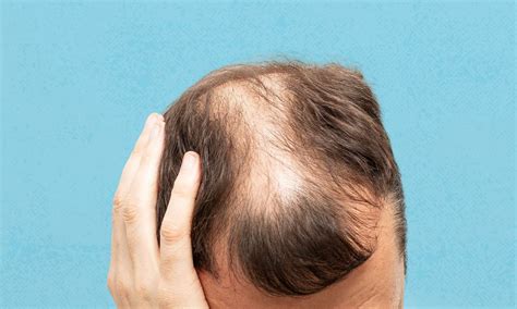Androgenetic Alopecia Severely Impacts Psychological Well-Being ...