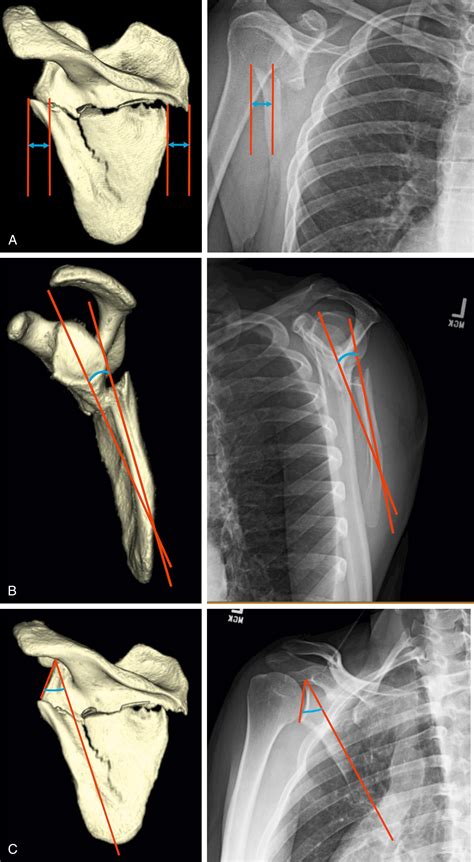 The Scapula—Body, Glenoid and Process Fractures - Clinical Tree
