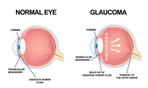 Glaucoma: Signs and Treatment | Neo Eye Clinic