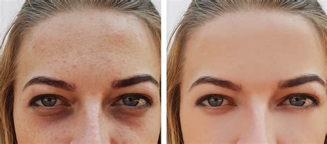 Under-Eye Dark Circle Treatment Calgary - Ensoul Aesthetic & Wellness