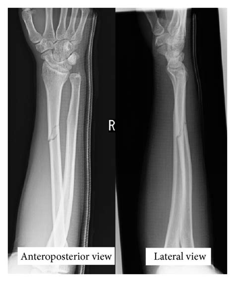 Image result for Fractured Radius