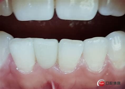 不磨牙，不种牙，不戴隐形牙-喀什鸿康口腔吴彬的博客-KQ88口腔博客