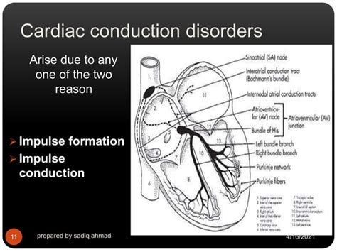 Image result for Cardiac Conduction Disorders Examples