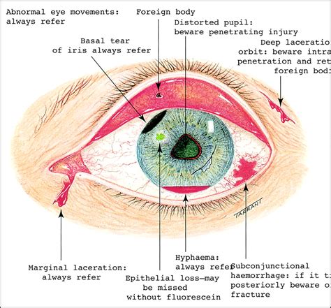Injury to the eye | The BMJ