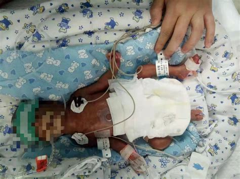 24周早产儿出生时仅750克，为救他，孩子父母期待大家都来帮一帮……_头版_中山手机台