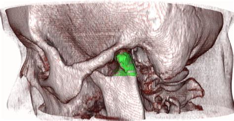 InVesalius Tutorial 的图像结果