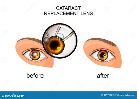 Replacement of the Crystalline Lens in Cataract Stock Vector - Illustration of oculist, care ...