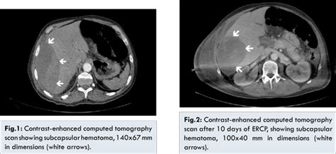 Subcapsular Hepatic Hematoma Following Endoscopic Retrograde ...