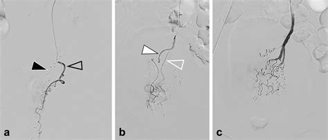 Embolization of the Superior Rectal Arteries versus Closed Hemorrhoidectomy (Ferguson Technique ...