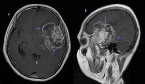 High-Grade Glioma | Aaron Cohen-Gadol MD