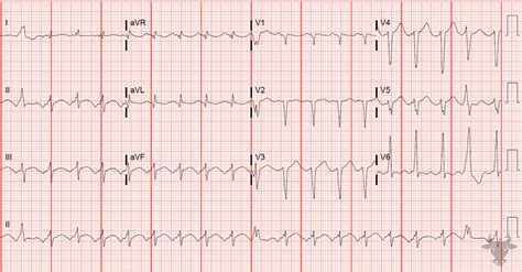 Atrial Tachycardia | ECG Stampede