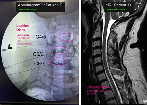 Cervical Spine Mri Comparison Contrast Enhanced T1 Weighted Head And