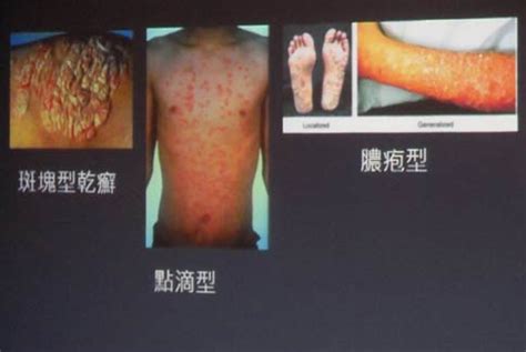 霉菌皮肤感染图片,皮肤霉菌症状图片,皮肤细菌图片_大山谷图库