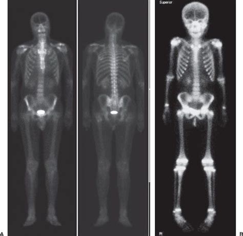 Image result for Normal Bone Scan