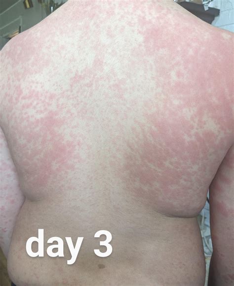 Rash From Amoxicillin