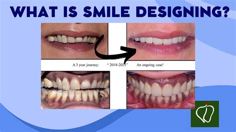 Idyll Dental: What is smile designing?
