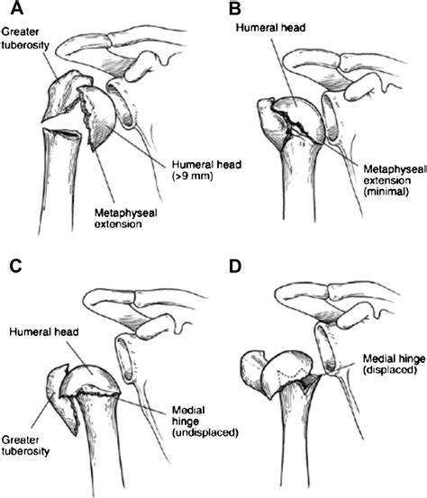 Humeral Head Fracture