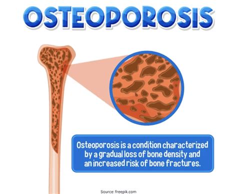 8 Essential Tips To Help Keep Your Bones Healthy And Strong