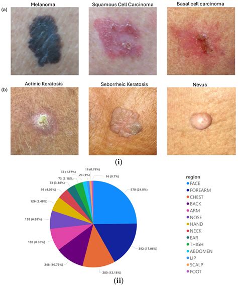 Deep Learning Approaches for the Classification of Keloid Images in the ...