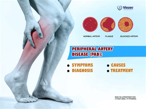 Fitt Guidelines For Peripheral Artery Disease at Chelsea Miles blog