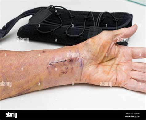 A hand with a visible surgical scar on the wrist shows signs of healing ...